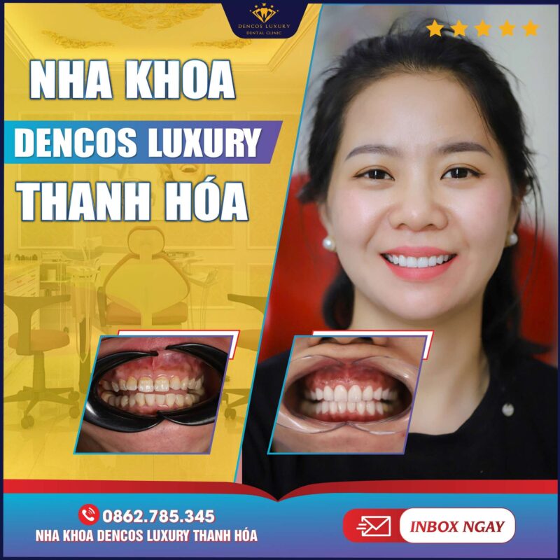 Sau Khi Bọc Răng Sứ – Nên Ăn Gì Để Răng Sứ Bền Đẹp Lâu Dài?