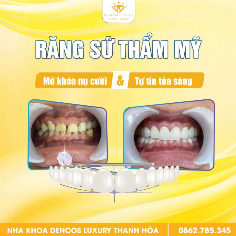 Sau Khi Bọc Răng Sứ – Nên Ăn Gì Để Răng Sứ Bền Đẹp Lâu Dài?