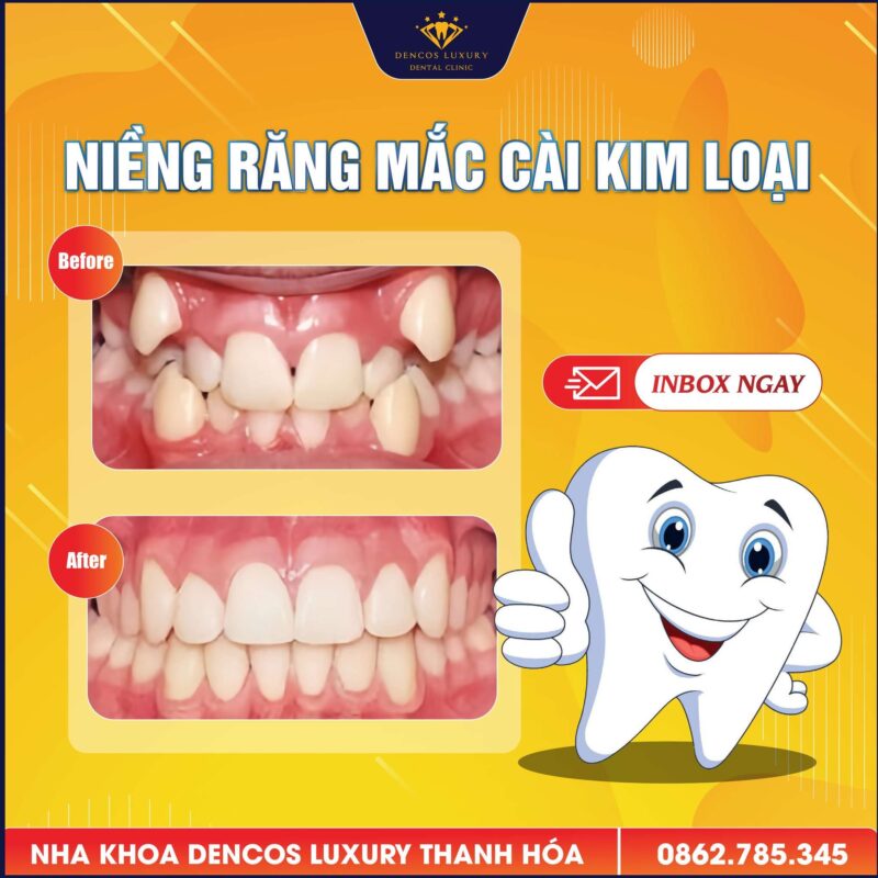 Dinh Dưỡng Cho Người Niềng Răng: Ăn Gì Để Không Đau Và Răng Vẫn Chắc?