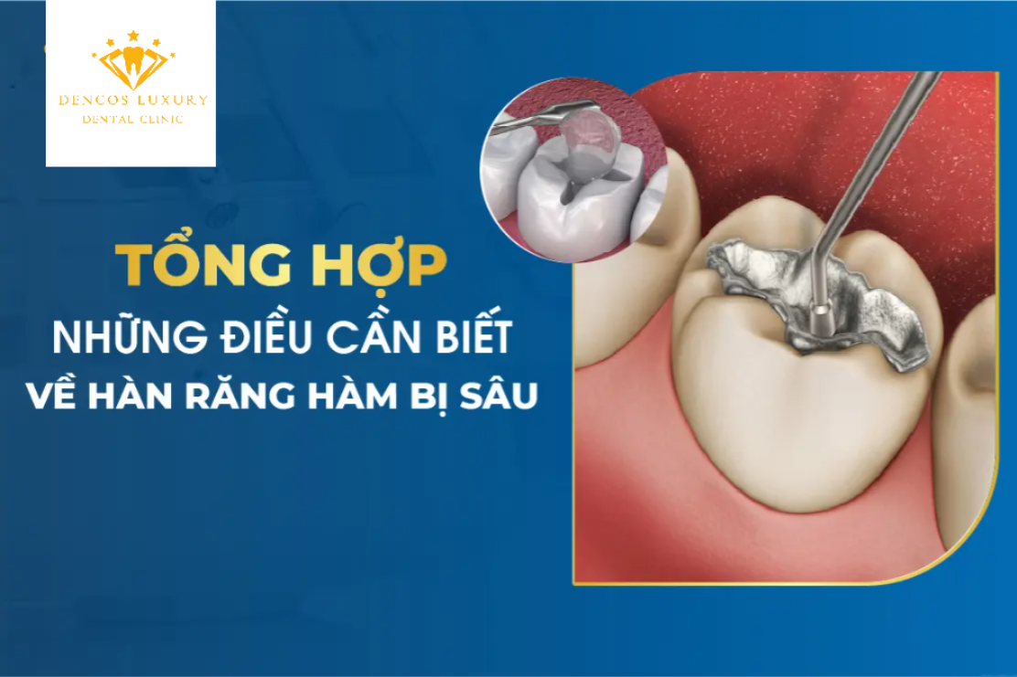 //nhakhoaident.com/kien-thuc-nha-khoa/han-rang-sau/