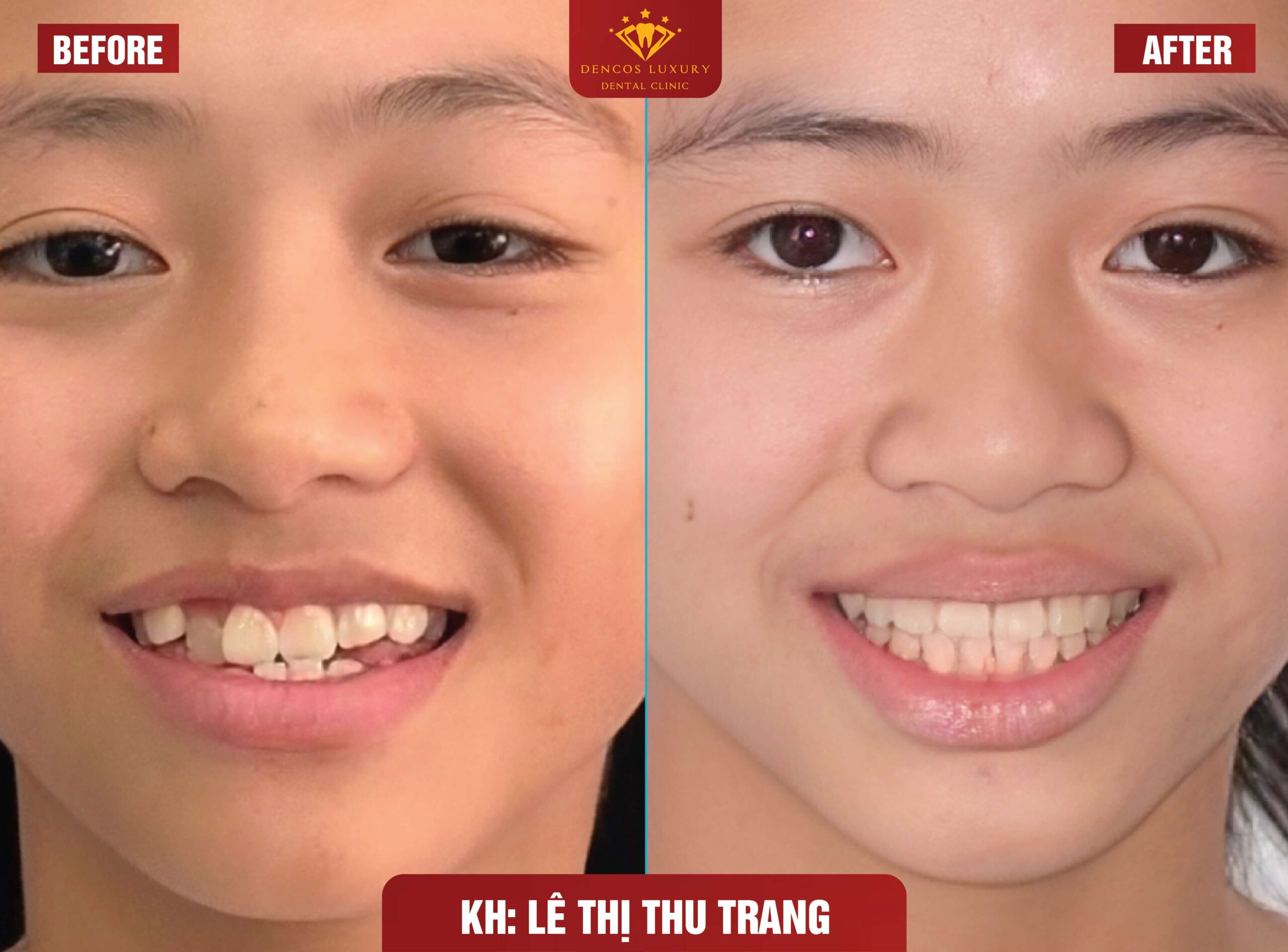 Những Trường Hợp Nào Thì Nên Niềng Răng?