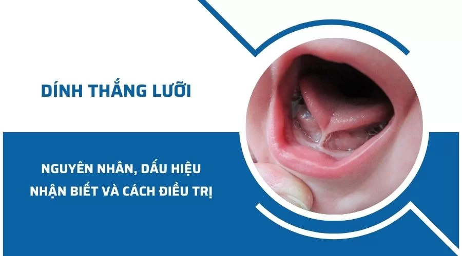 //nhakhoakim.com/dinh-thang-luoi.html