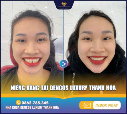 Niềng răng xong mà ăn đồ dẻo dai? Cẩn thận mất tiền oan!