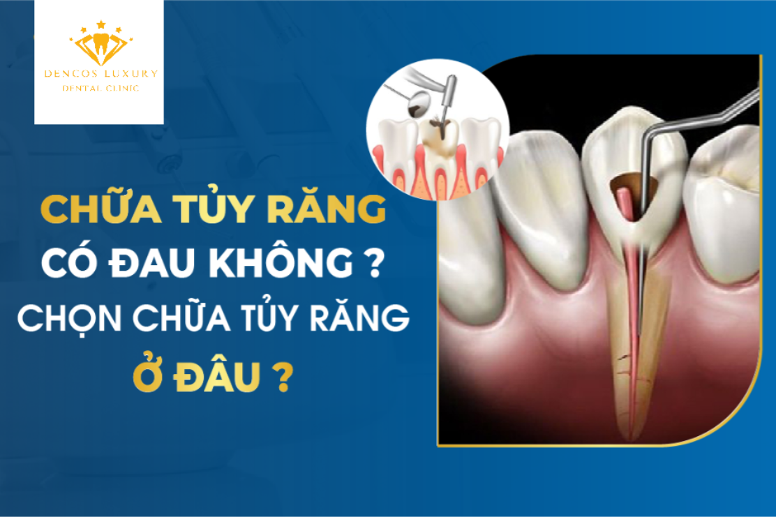 //nhakhoakaiyen.com/blogs/nha-khoa-tong-quat/lay-tuy-rang-la-gi