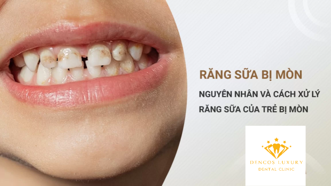 //nhakhoakim.com/nguyen-nhan-va-cach-xu-ly-khi-rang-sua-cua-tre-bi-mon.html