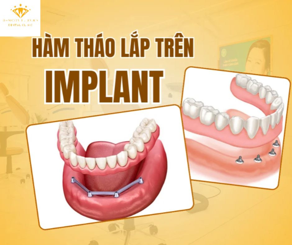 //nhakhoarangxinh.com.vn/ham-thao-lap-tren-implant/