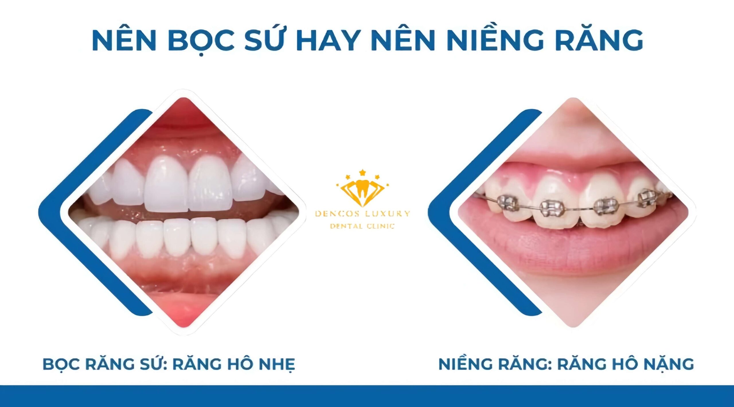 //nhakhoakim.com/boc-rang-su-co-het-ho-khong.html