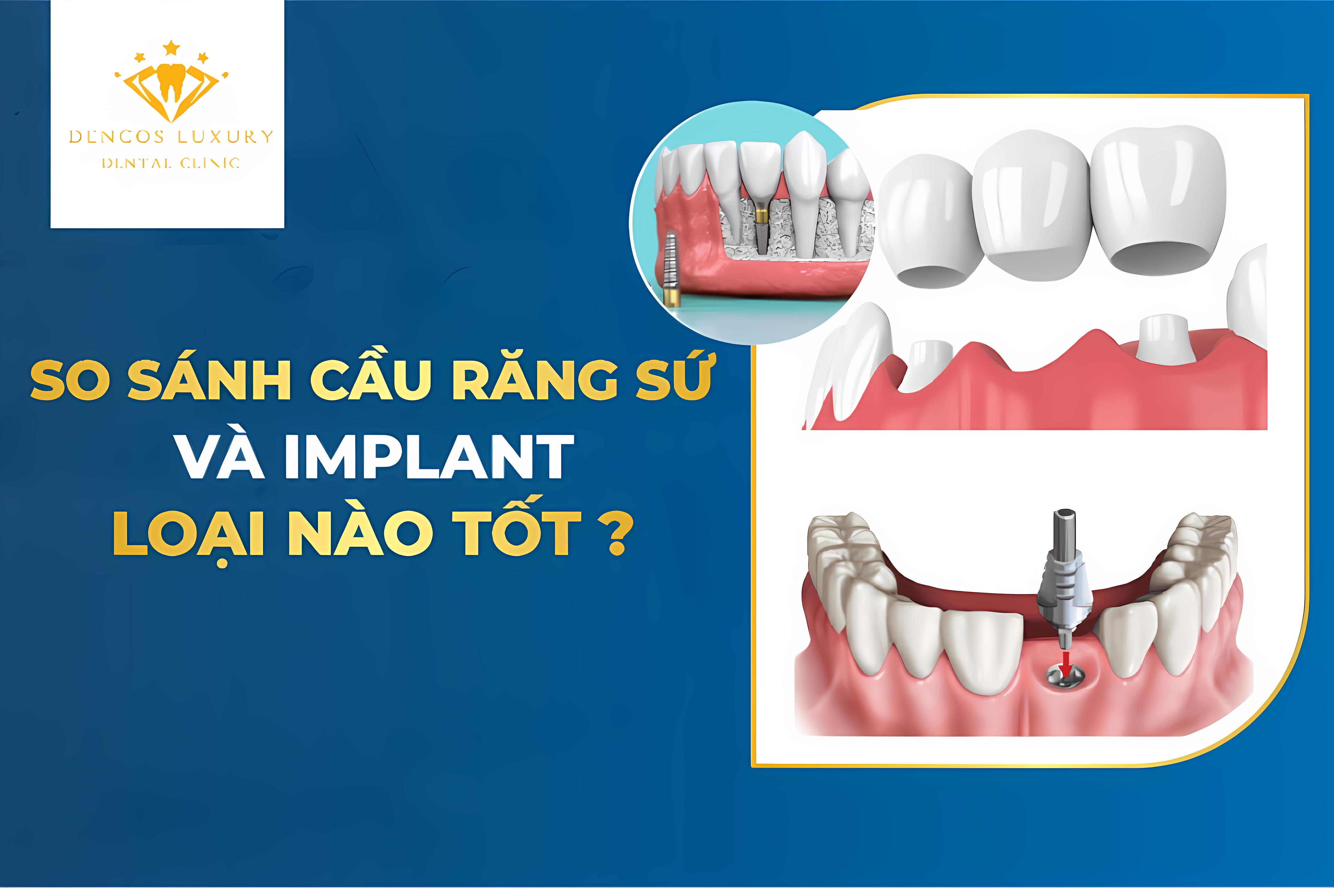 https://nhakhoaquoctemia.com/so-sanh-cau-rang-su-va-implant/