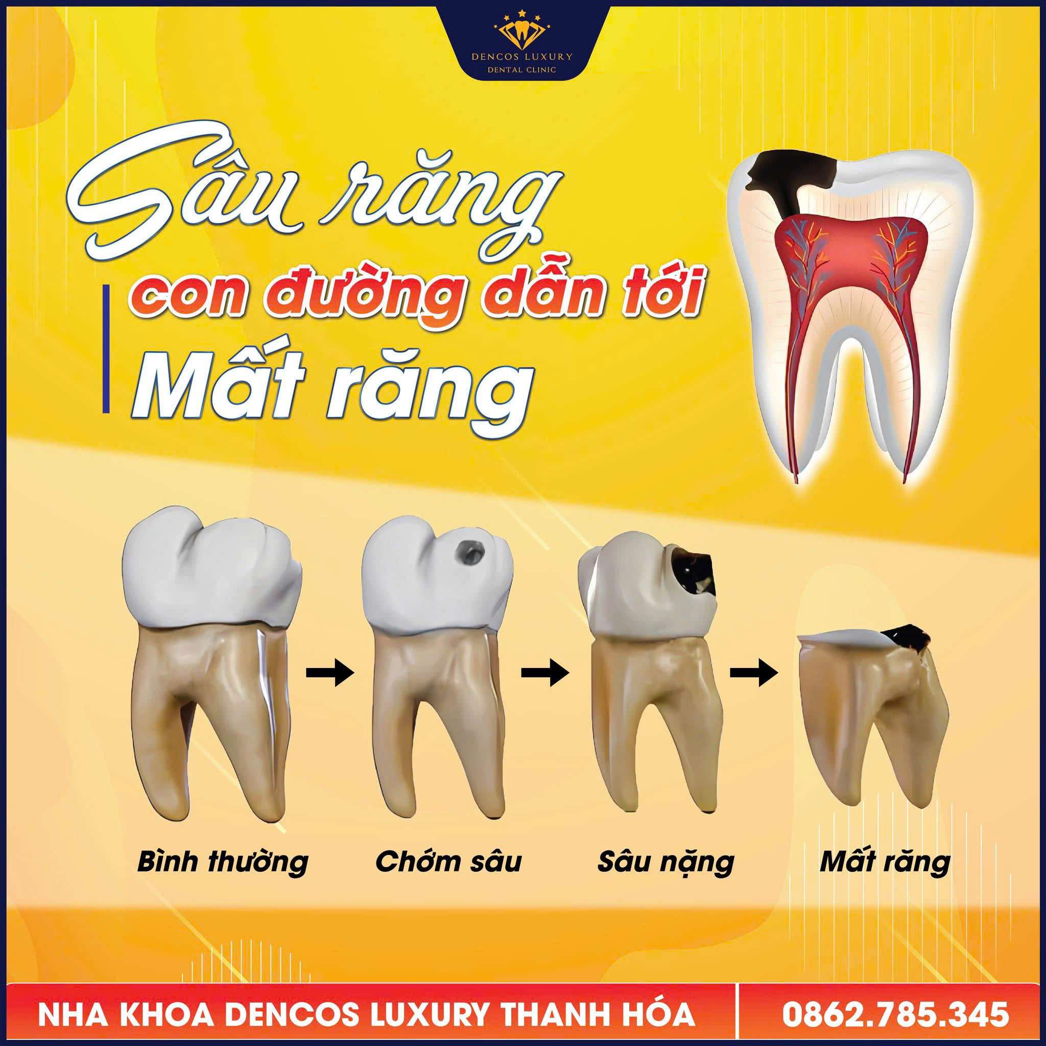//nhakhoaident.com/kien-thuc-nha-khoa/sau-rang/