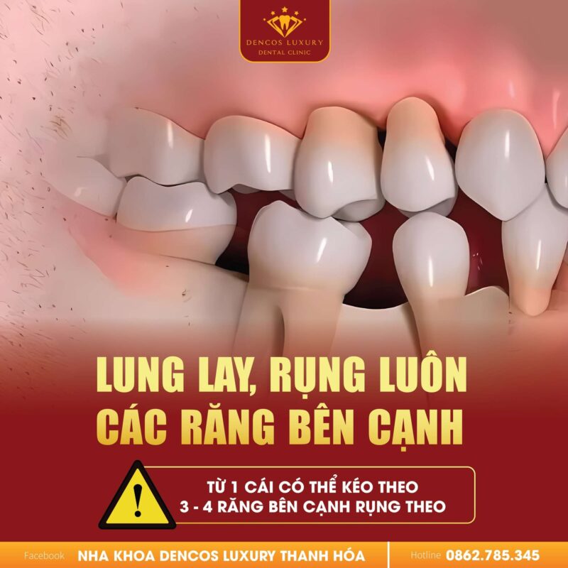 Răng Mất 1, 2 Cái Đừng Coi Thường?