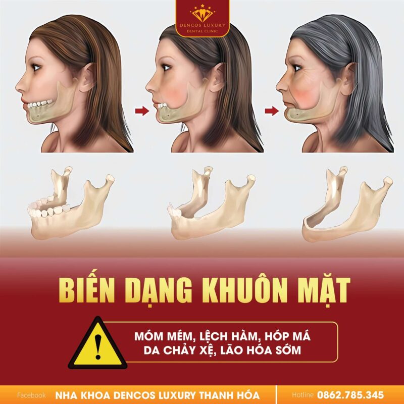 Răng Mất 1, 2 Cái Đừng Coi Thường?