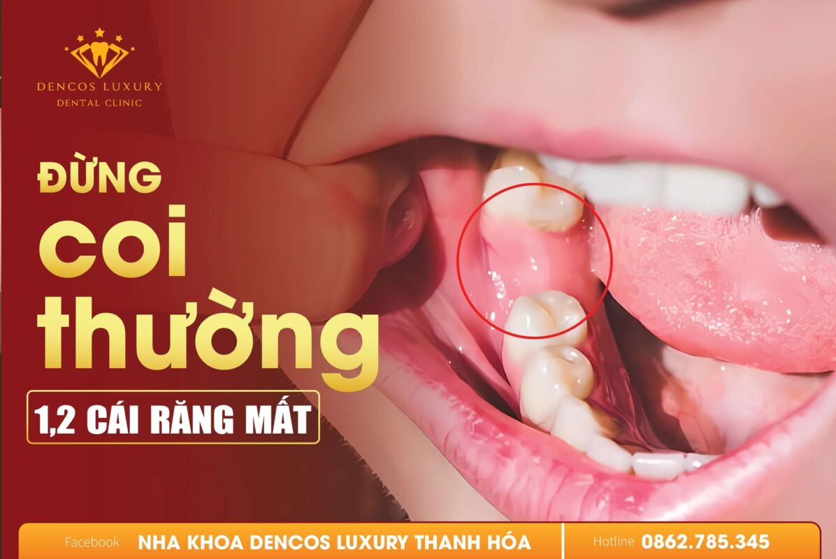 Răng Mất 1, 2 Cái Đừng Coi Thường?