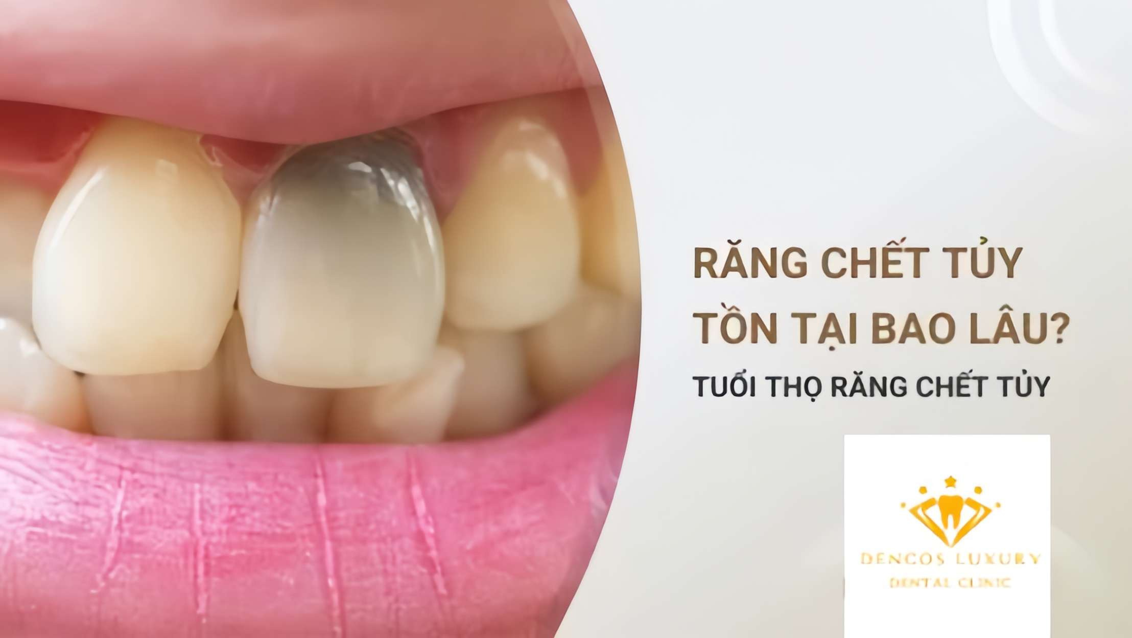 https://nhakhoakim.com/rang-chet-tuy-ton-tai-duoc-bao-lau.html