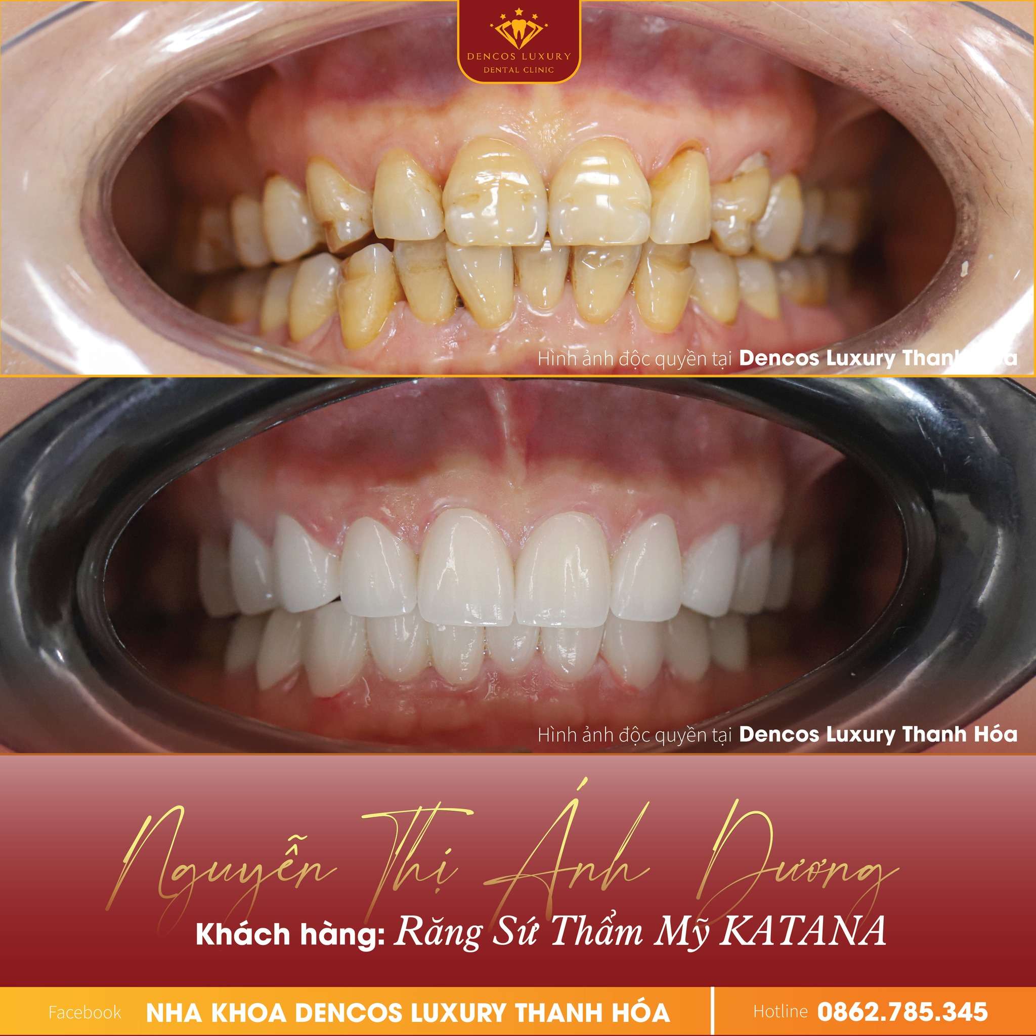 Ưu đãi cực sốc bọc sứ thẩm mỹ tự tin đón xuân