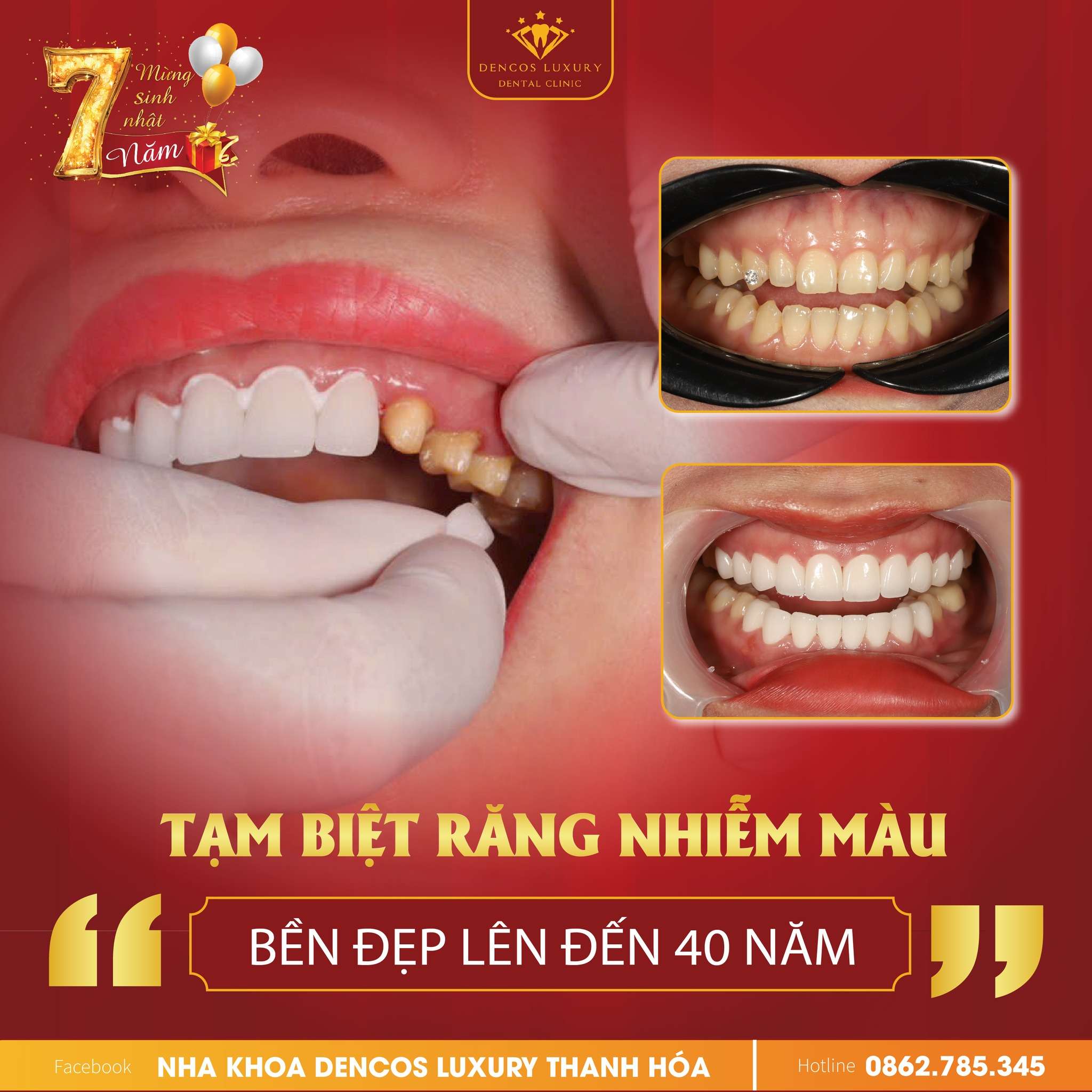 Bọc răng sứ Tết tỏa sáng trong mọi khoảnh khắc